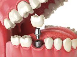 cost of full mouth dental implants