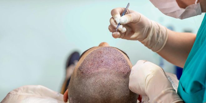 hair transplantation in Udaipur