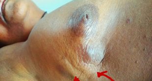 breast cancer lumps