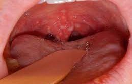 throat cancer patients