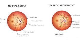 Diabetic Retinopathy - Featured Image