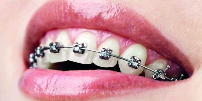Invisalign Braces
