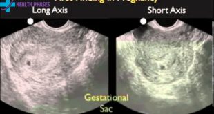 Intrauterine Pregnancy