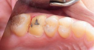 cavity between front teeth